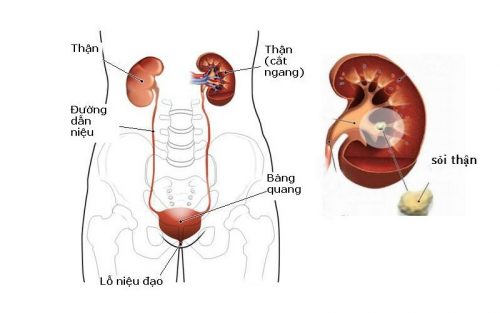 Bệnh sỏi thận
